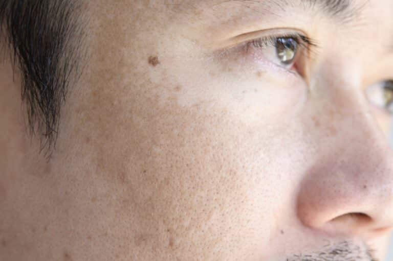 Tratamiento de manchas faciales en Madrid: piel masculina con manchas y lunares