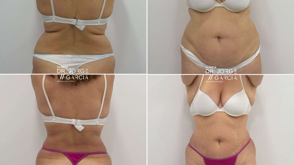 Antes y después de láser lipólisis en abdomen, flancos y espalda realizados en la Clínica Dr. Jorge García, con reducción de grasa localizada y mejora del contorno corporal.