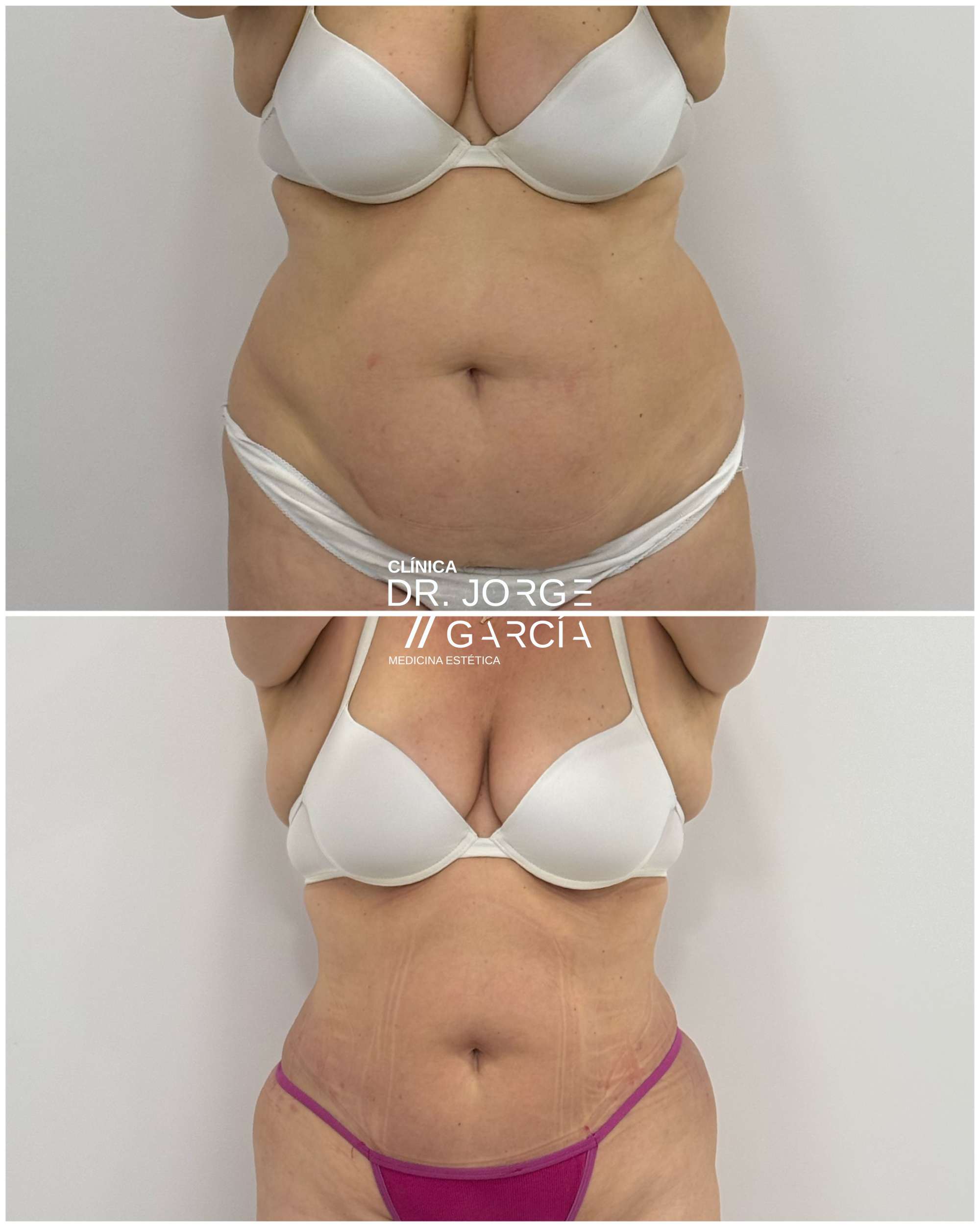 Antes y después de láser lipólisis en abdomen en una mujer de 60 años, mostrando eliminación de grasa localizada y mejora del contorno corporal en la Clínica Dr. Jorge García.