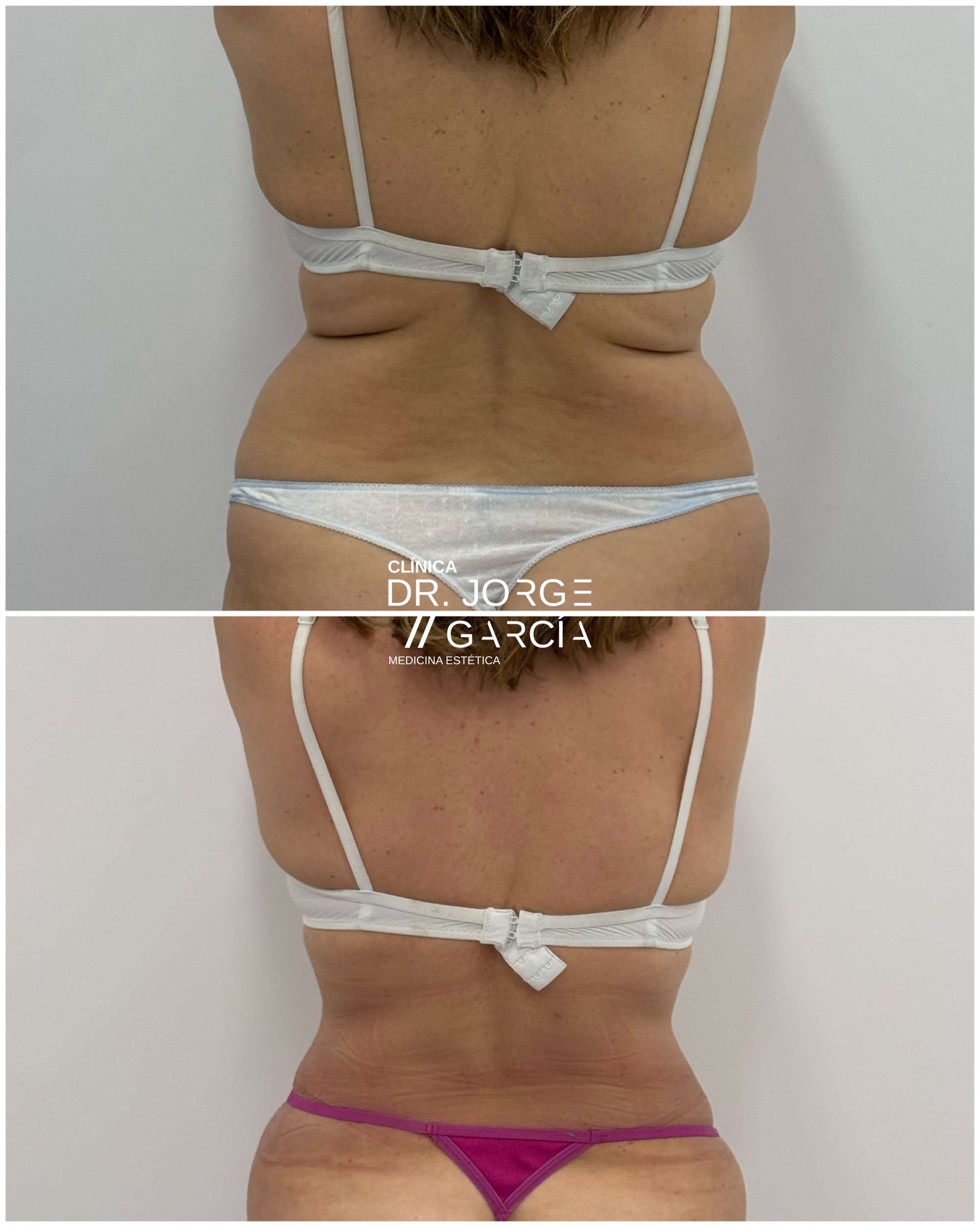 Resultados antes y después de láser lipólisis en espalda y flancos en una mujer de 60 años para reducir grasa localizada en Clínica Dr. Jorge García, tratamiento de remodelación corporal.