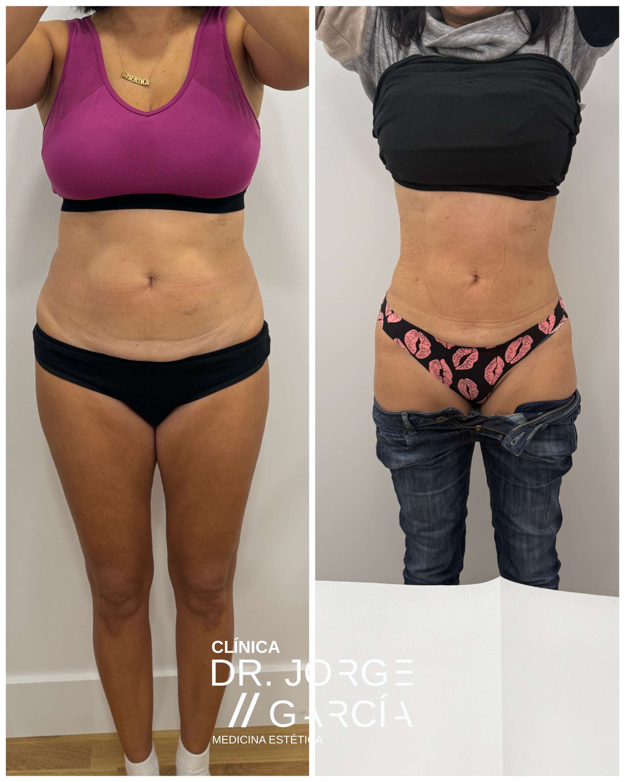 Resultados antes y después de láser lipólisis en espalda y flancos en una mujer de 48 años, con reducción de grasa localizada y mejora del contorno corporal en la Clínica Dr. Jorge García.