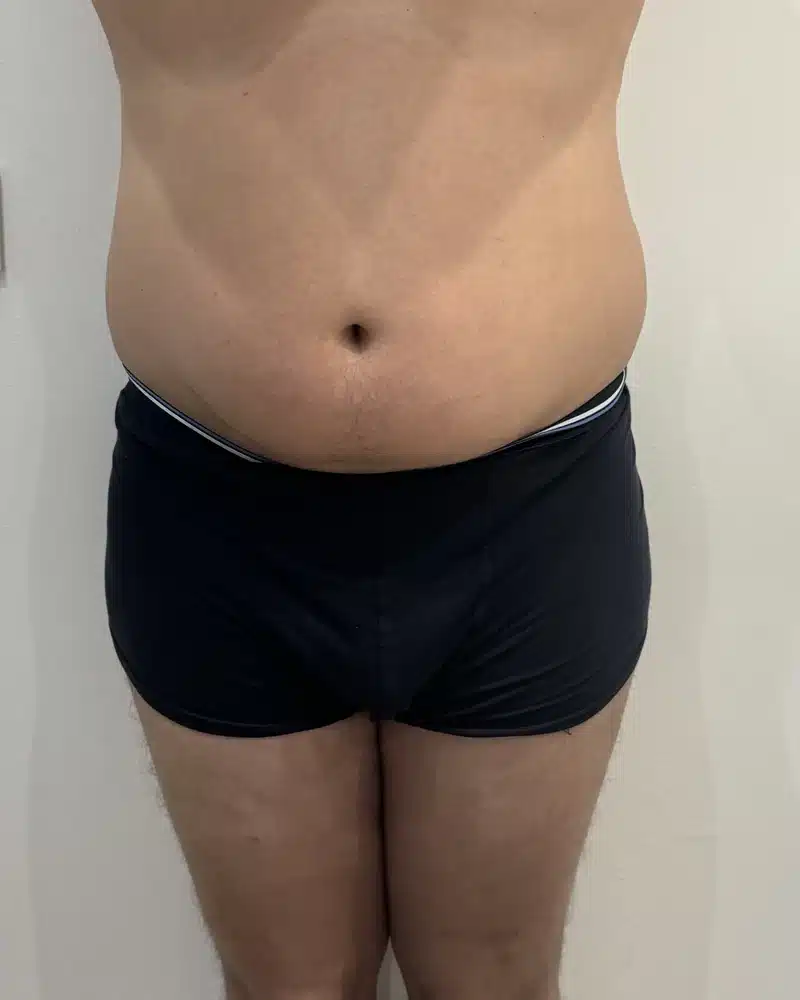 lipo laser antes y despues