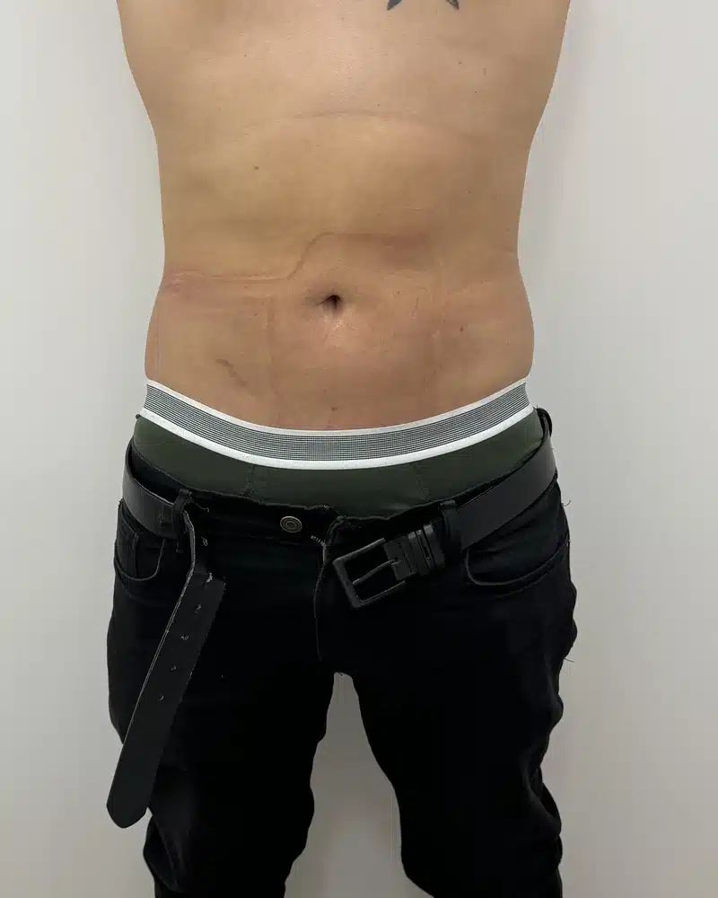 lipo laser antes y despues