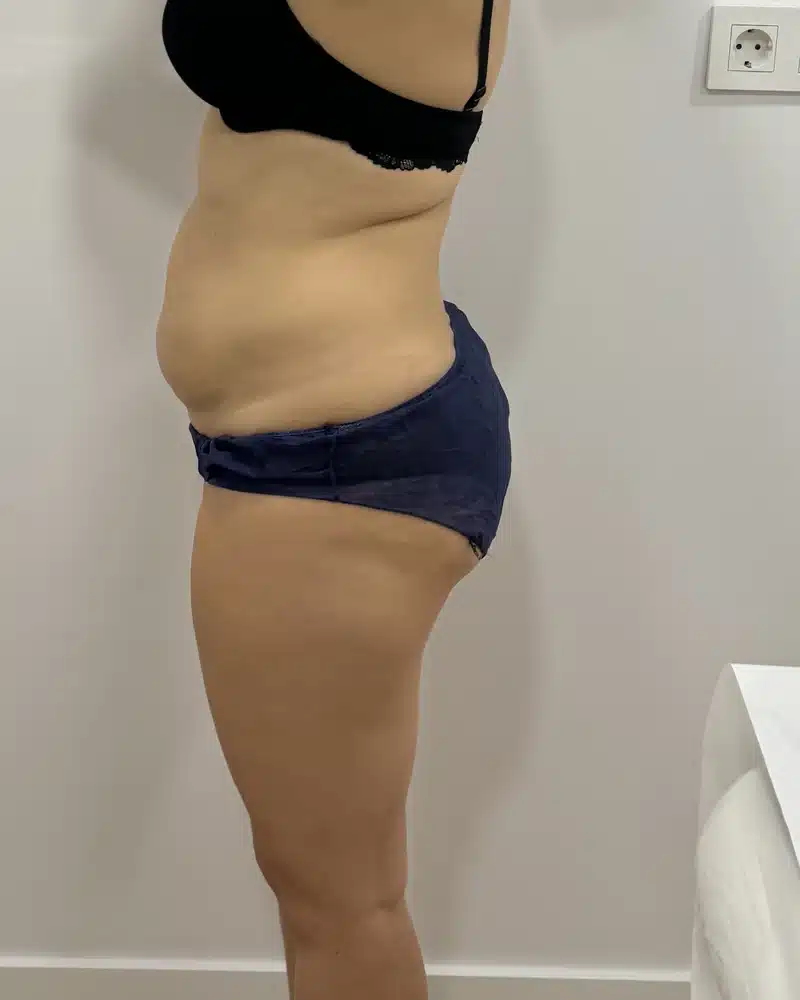 lipo laser antes y despues