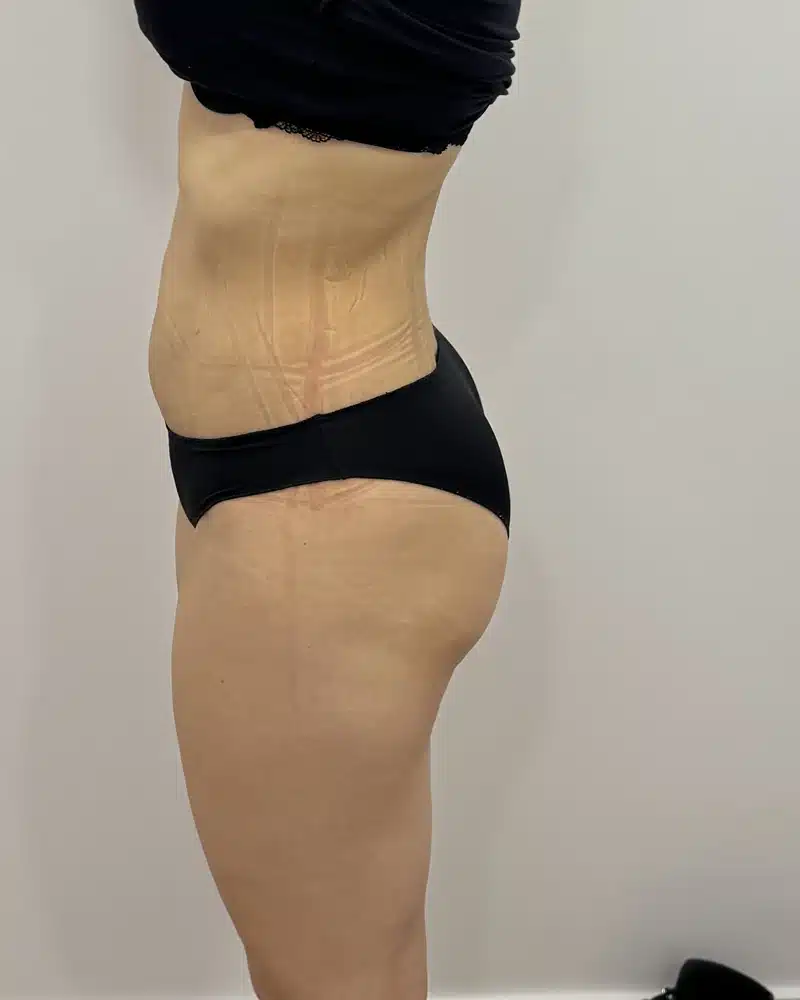 lipo laser antes y despues